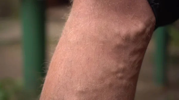 Primo piano delle vene varicose e delle macchie di età su una gamba umana. — Foto Stock