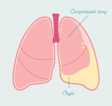 Chylothorax in human lung. Accumulation of lymph in pleural space - vector anatomical scheme clipart