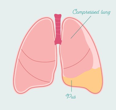 Pyothorax in human lung. Pleural empyema, gathering of pus in pleural space - vector anatomical scheme clipart