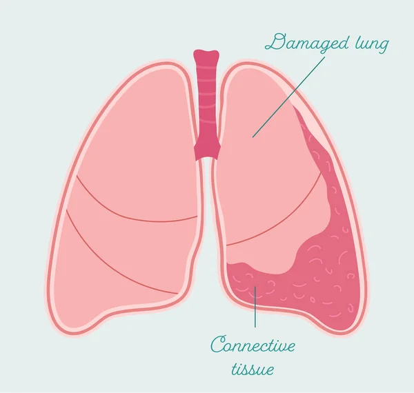 Fibrotórax en pulmón humano. Fibrosis de la cavidad pleural con pulmón comprimido esquema anatómico vectorial — Archivo Imágenes Vectoriales