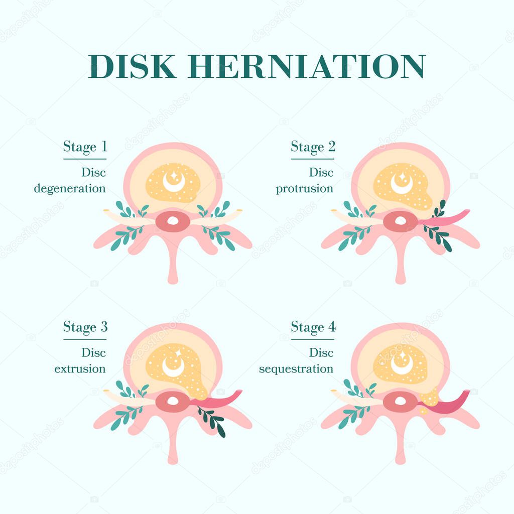 Intervertebral disc herniation, patient-friendly diagra, cross section
