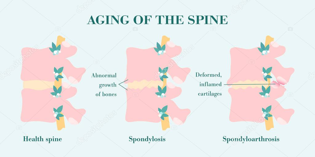 Aging and degeneration of spine columns, patient-friendly diagram