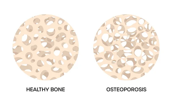 Osso sano e osteoporoso, illustrazioni rotonde su sfondo bianco — Vettoriale Stock