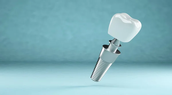 Implant Dentystyczny Proteza Stomatologiczna Przestrzenią Kopiowania — Zdjęcie stockowe
