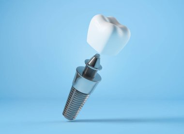 Dental implant on blue background, 3d rendering