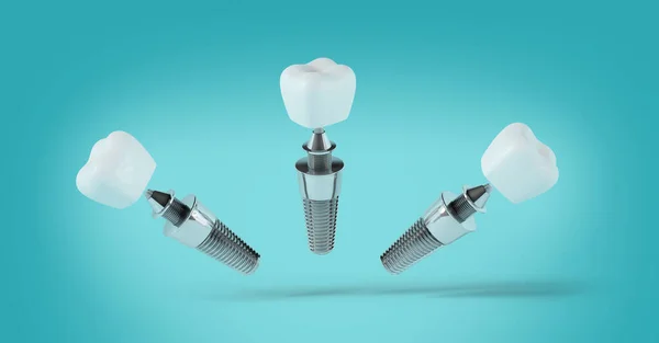 Dental Implant Different Positions Blue Background Rendering — Stock Photo, Image