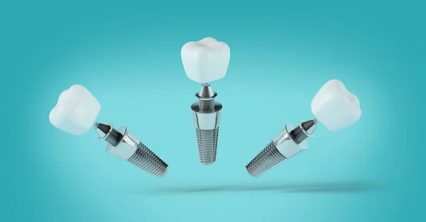 Diş implantı mavi arka planda farklı pozisyonlarda. 3d oluşturma