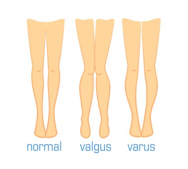 valgus varus ve normal