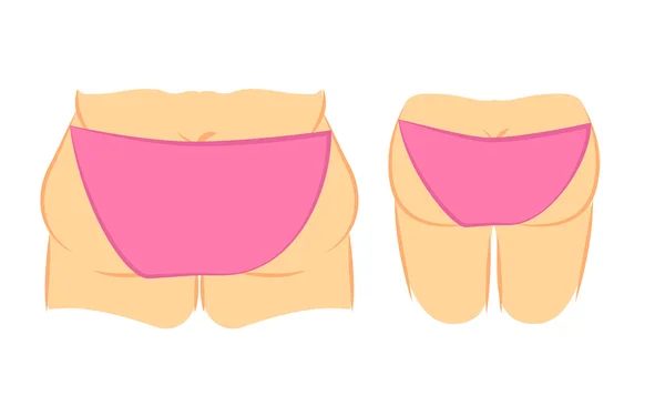 Butt lift correction — Stockový vektor