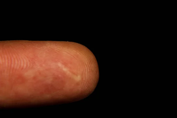 Dedo Hombre Con Una Cicatriz Borrosa Sobre Fondo Oscuro — Foto de Stock
