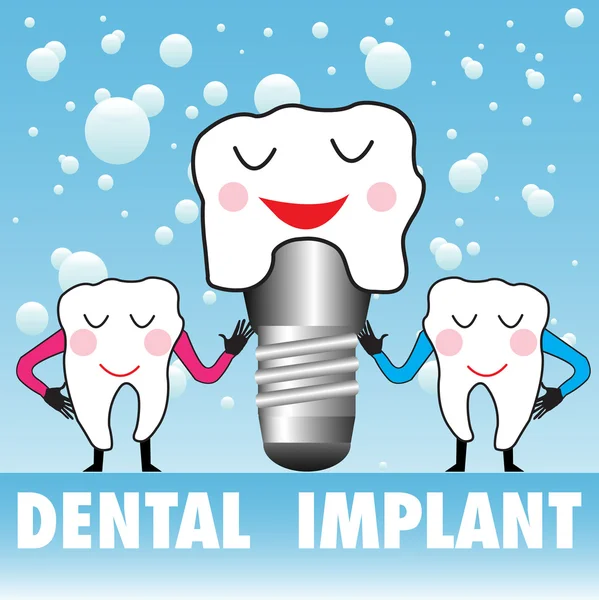 Fogászati implantátum — Stock Vector