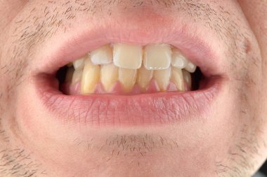 Adamın dişlerini gösteren ayrıntılı görüntü. Dişlerle ilgili sağlık kaygı. Hyg