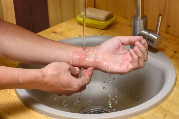 Man Washes Abrasion His Arm Running Water — Stock Photo, Image