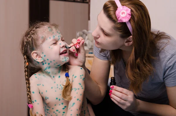 Mama się rozmazuje dziecko z Ospa wietrzna rany zelenkoj — Zdjęcie stockowe