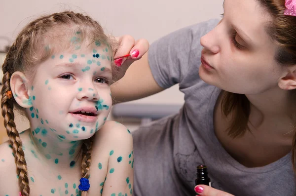 Mamma manca zelenkoj eruzione cutanea sul viso del bambino con varicella — Foto Stock