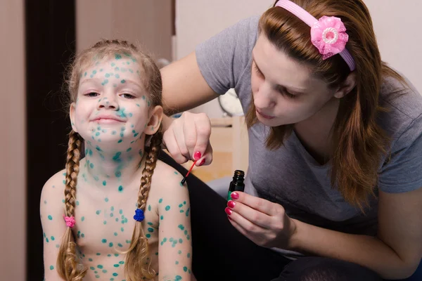 Mom misses the little girl with chickenpox sores zelenkoj — Stock Photo, Image