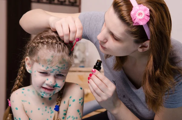 Mom plaster zelenkoj child with chickenpox sores — Stock Photo, Image