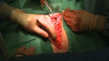 cerrahlar göğüs kesik dikiş