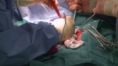 Hücre-hurda ve elektrokoter ameliyat sırasında kullanan cerrah