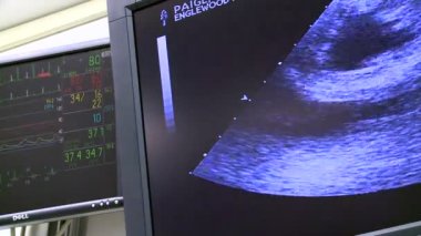 Atışı monitör ve ultrason monitör