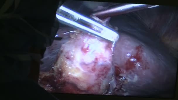 Monitor de vídeo utilizado durante la laparoscopia — Vídeos de Stock