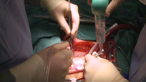 Irrigação durante a cirurgia — Vídeo de Stock