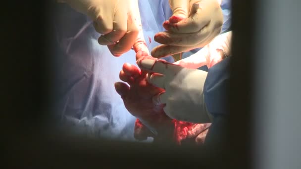 Surgeons performing a medical operation — Stock Video