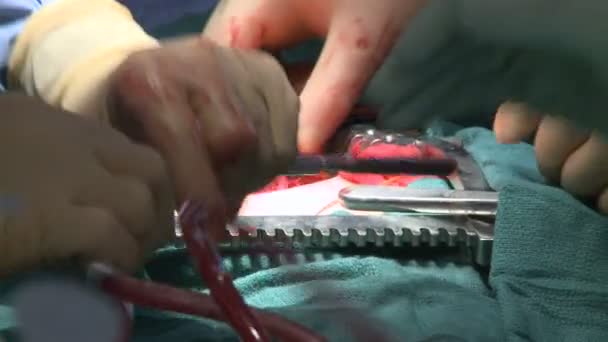 Surgeons performing a medical operation — Stock Video