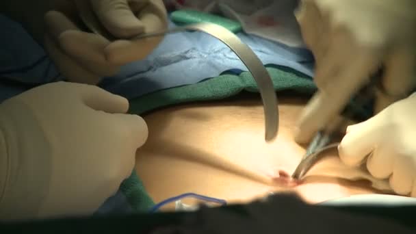 Chirurg macht Schnitte für laparoskopische Chirurgie — Stockvideo