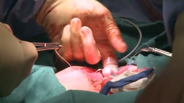 Surgeon using wire to stitch ribcage — Stock Video