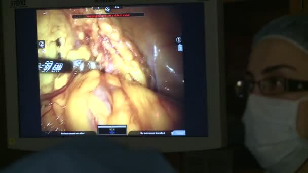 Robotica chirurgie van de baarmoeder — Stockvideo