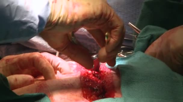 Médecins travaillant dans l'incision abdominale — Video