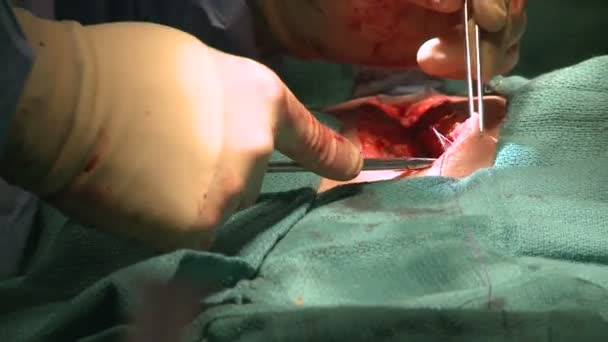 Surgeon stitching up abdomen — Stock Video