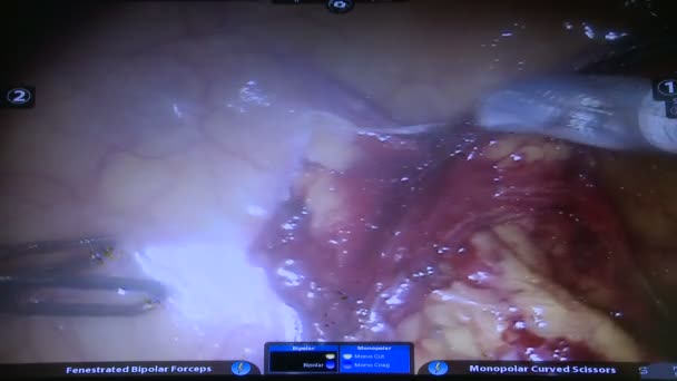 En syn på arbete inne en robotic kirurgiska enheten — Stockvideo