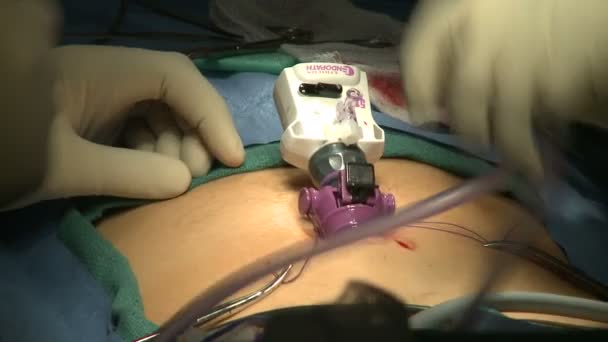 Laparoscopische apparatuur is voor chirurgie ingevoegd — Stockvideo