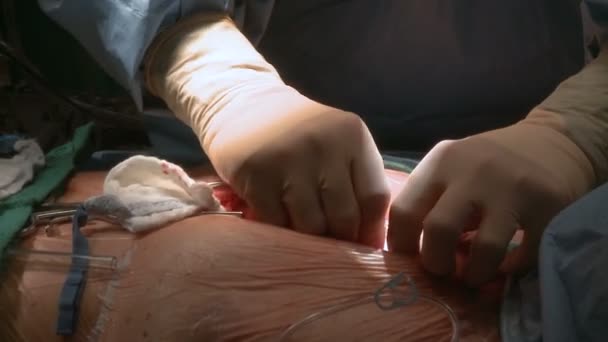 外科医クリーニング リブ リトラクター — ストック動画