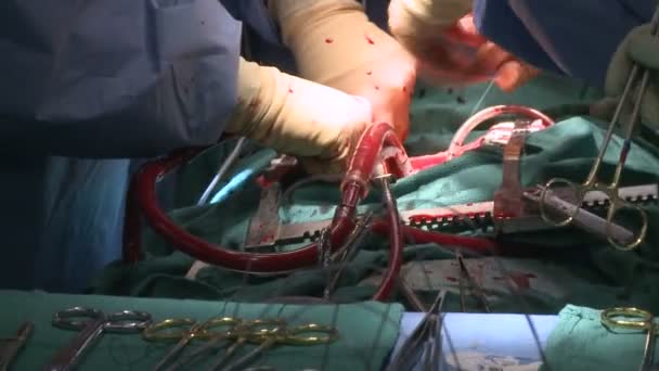 Equipe cirúrgica durante a operação — Vídeo de Stock