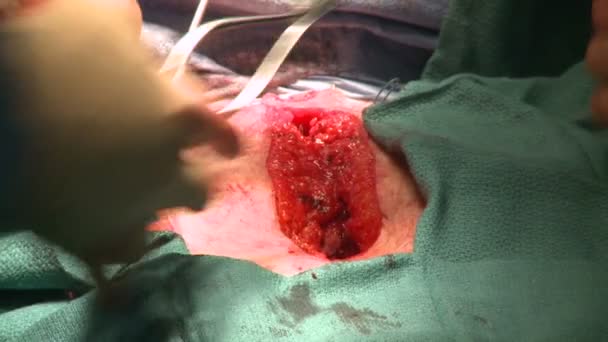 Médecins travaillant dans l'incision abdominale — Video