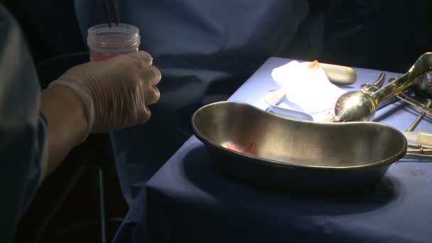 Robotic removal of the uterus — Stock Video