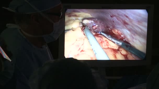 Overhead flatscreen for laparoscopic surgery — Stock Video