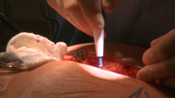 Cerrah electrocauterization kullanır — Stok video