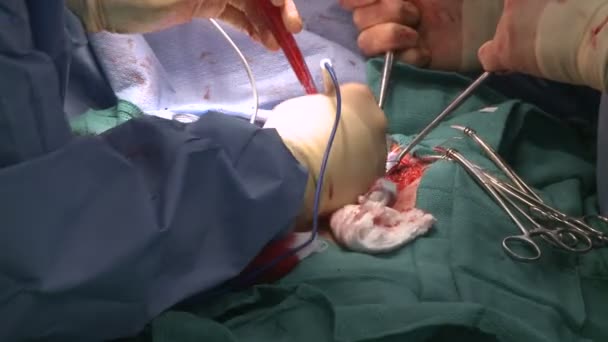 Хирург с использованием клеточной и электрокаутерии во время операции — стоковое видео