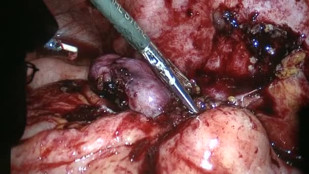 Un'appendice gravemente infetta — Video Stock