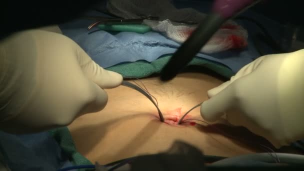 L'équipement laparoscopique est inséré pour la chirurgie — Video