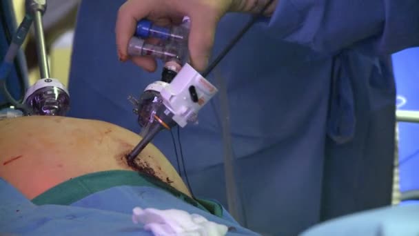 Chirurgiens effectuant une opération médicale — Video