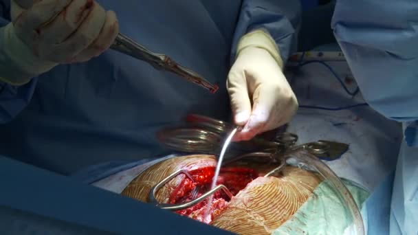 Cirurgiões realizam a operação — Vídeo de Stock