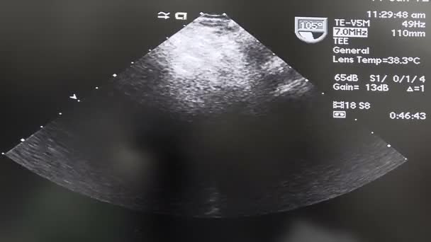 Monitor de ultrassom durante a cirurgia — Vídeo de Stock