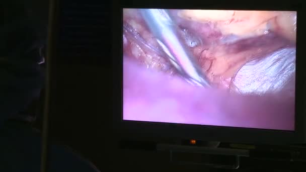 Monitor de vídeo usado durante a laparoscopia — Vídeo de Stock