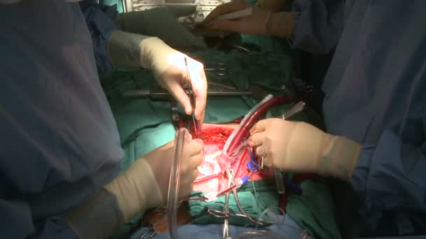 Хирурги работают вместе над пациентом с сердцем — стоковое видео