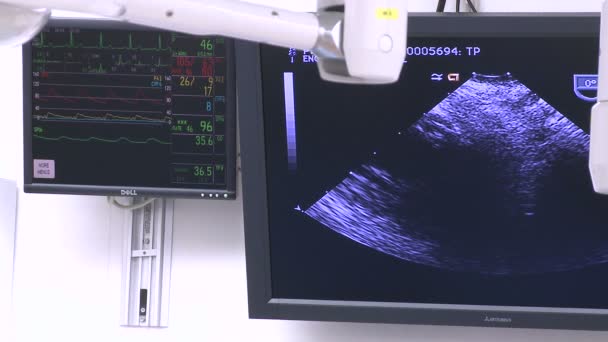 Vitals and ultrasound monitors — Stock Video